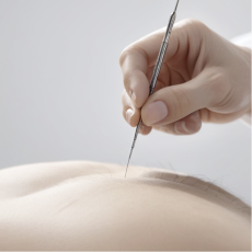 Acupuncture